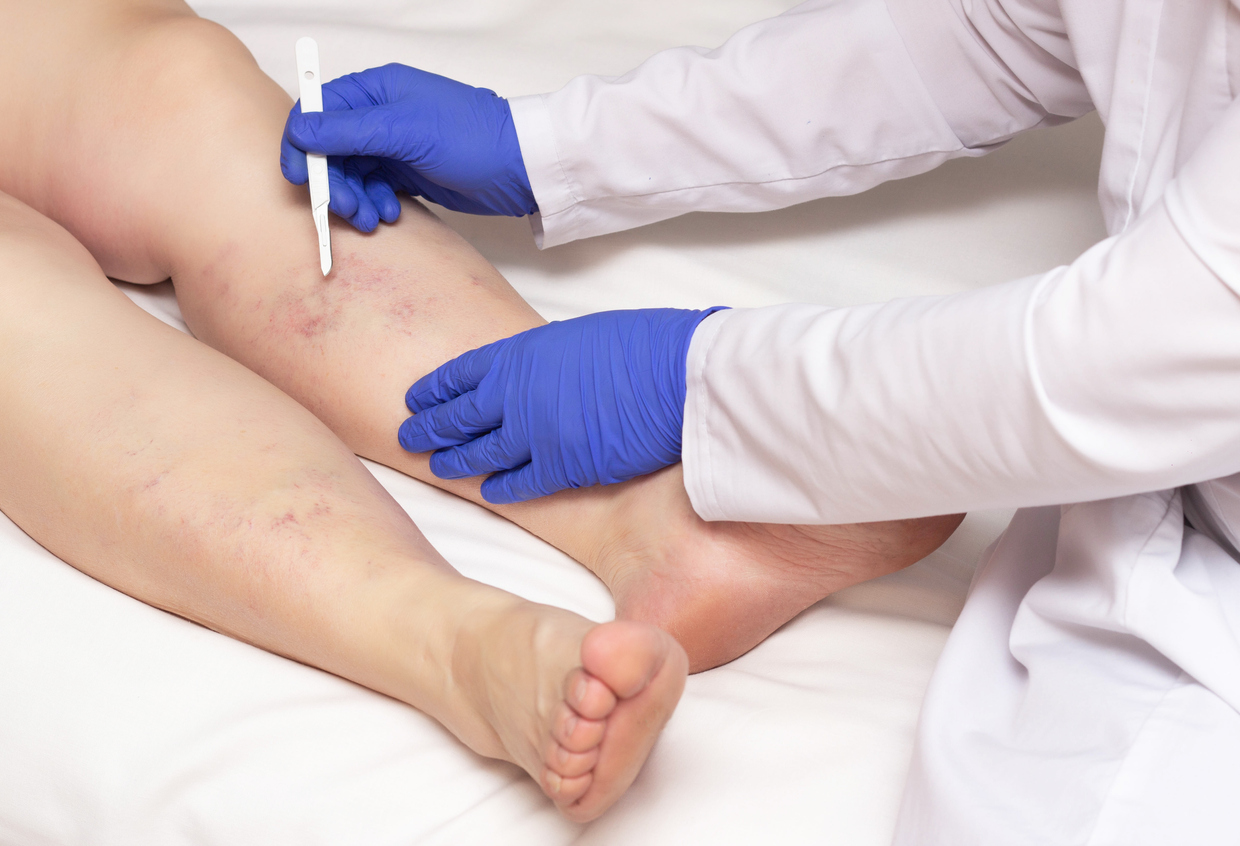 How can a vascular specialist help you get rid of leg pain?