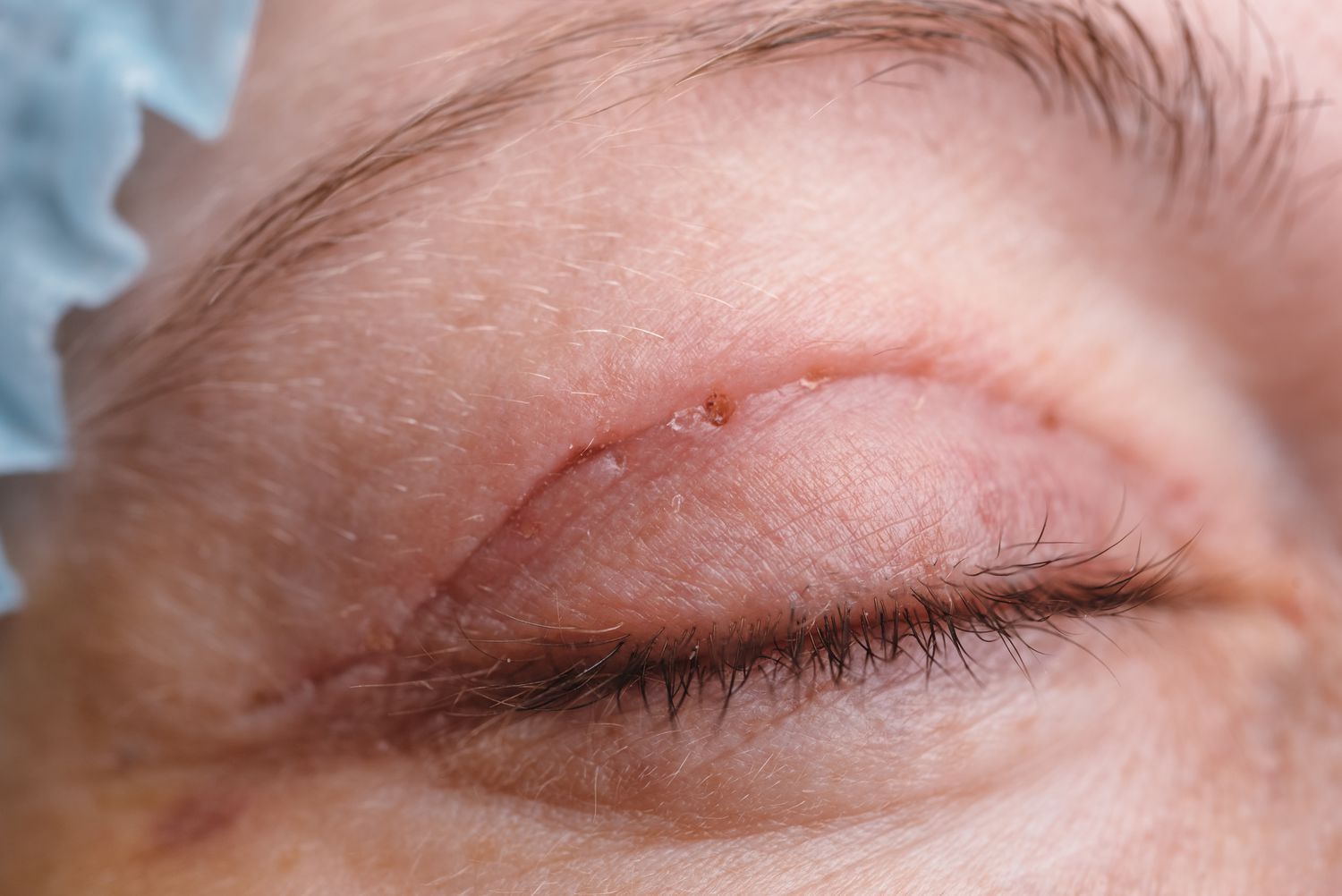 Can A Blepharoplasty Be Corrected? 