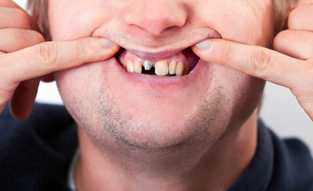 Understanding the Aftereffects of Dental Implants