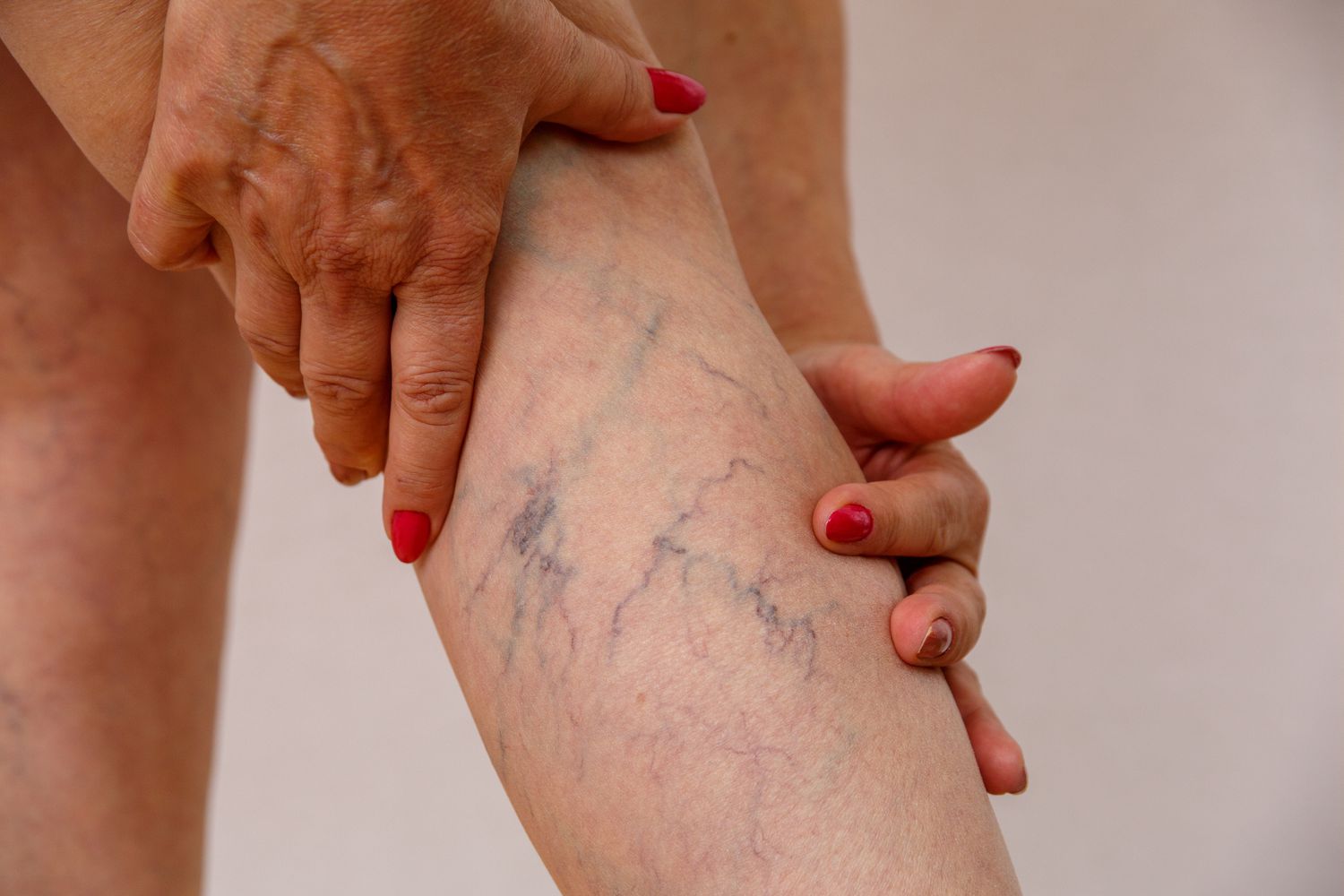 The Emotional and Physical Toll of Living with Varicose Veins 