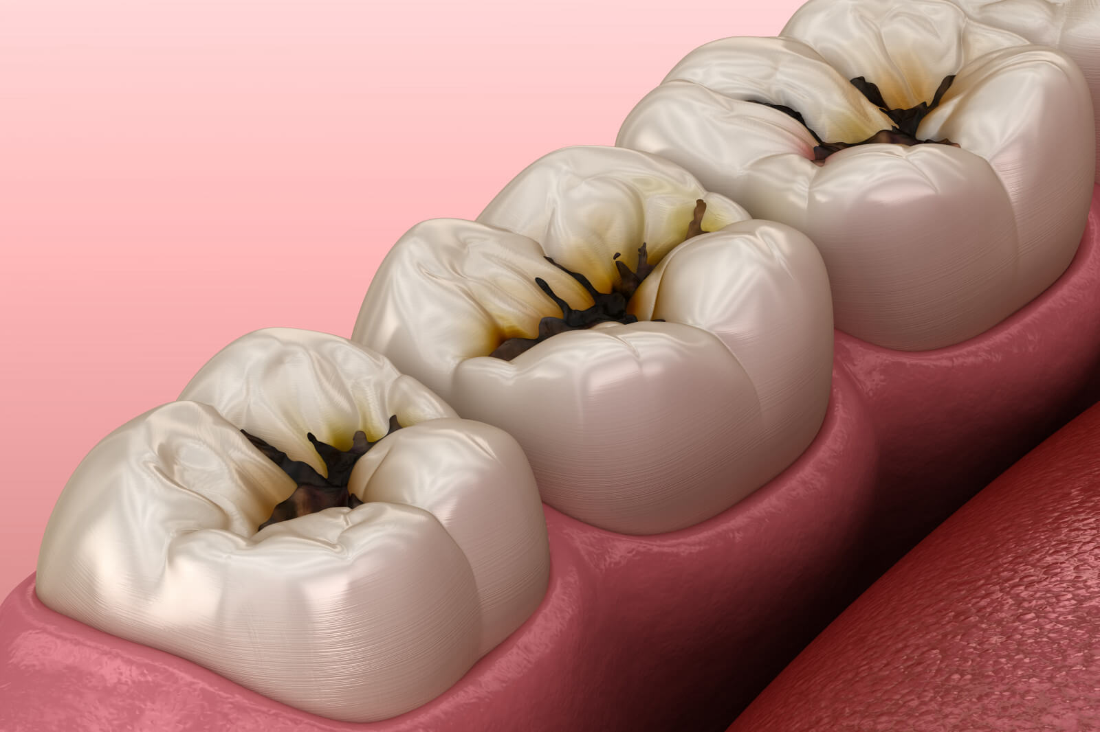 How Dentists Treat Pulpitis and Tooth Inflammation