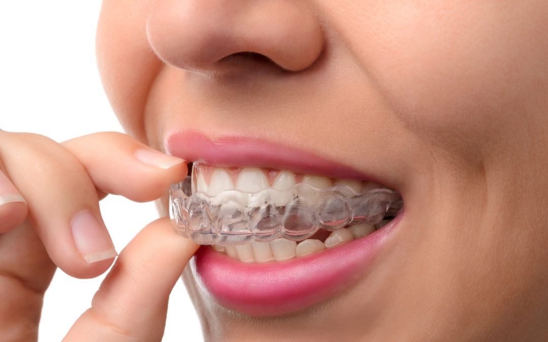 Improving Your Smile in Brookhaven, GA: What Options Can Your Dentist Recommend?