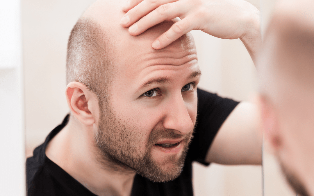 The Science Behind How Men Lose Their Hair and When They Should Seriously Consider a Hair Restoration Operation